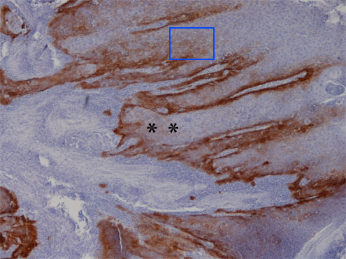 Immunhistochemische Darstellung der Invasionsfront