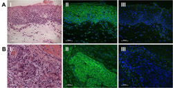 Immunfluoreszenzmarkierung der Hbd-3 Expression im Plattenepithelkarzinom der Mundhöhle mit HE- und Negativ-Kontrolle