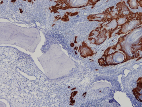 Markierung invasiver Tumorzellen